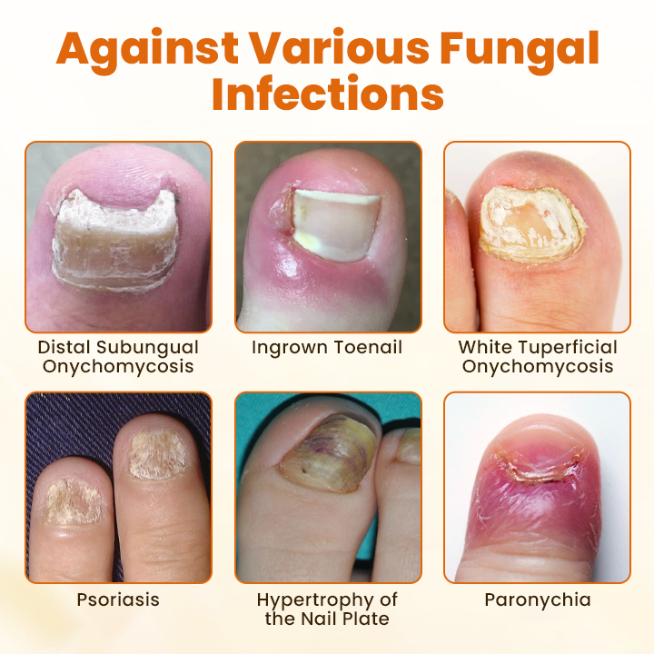 Timilk®  FungiBee Advanced Nail Repair Spray.