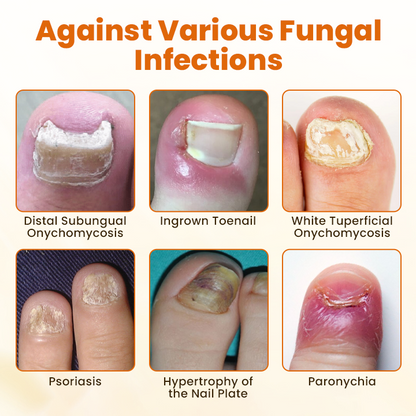 Timilk®  FungiBee Advanced Nail Repair Spray.