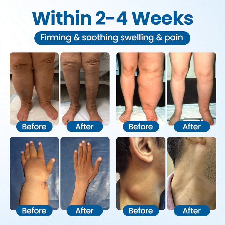 Timilk® Lymphora Swelling Relief Roll-On.